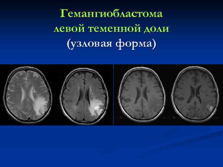 Гемангиобластома левой теменной доли (узловая форма) 