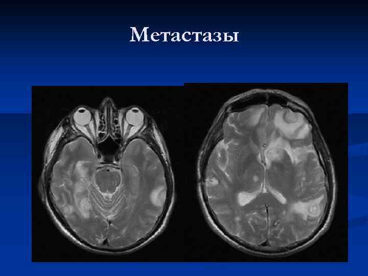 Метастазы 