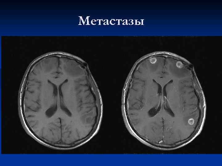 Метастазы 