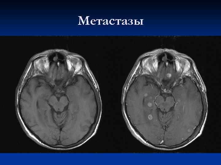 Метастазы 