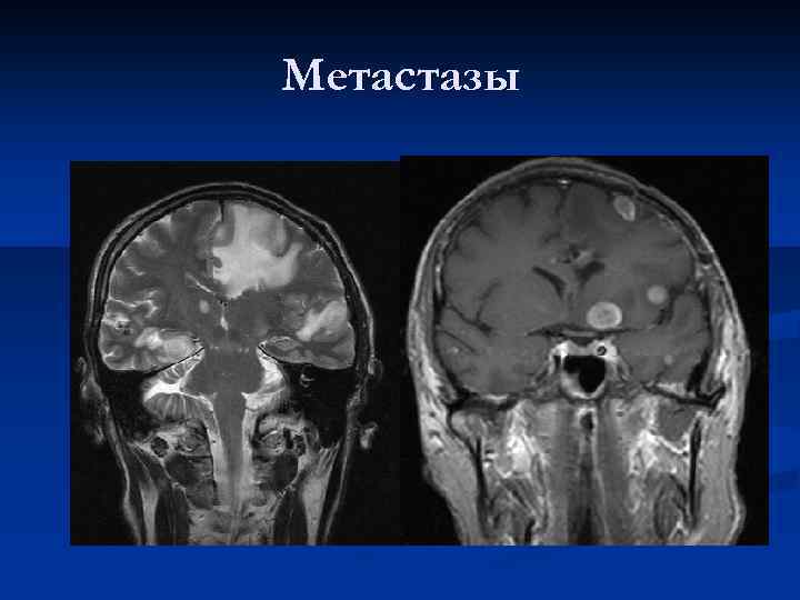Метастазы 