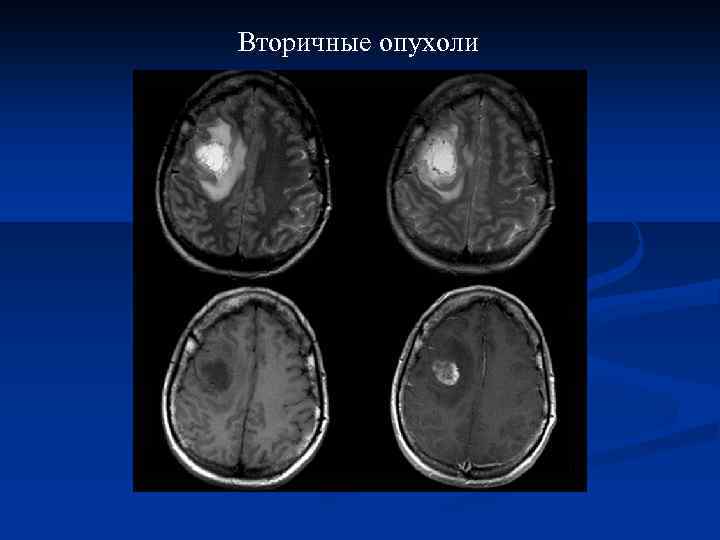 Вторичные опухоли 
