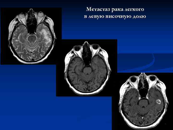 Метастаз рака легкого в левую височную долю 