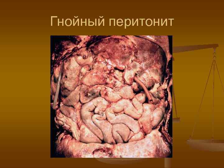 Гнойный перитонит 