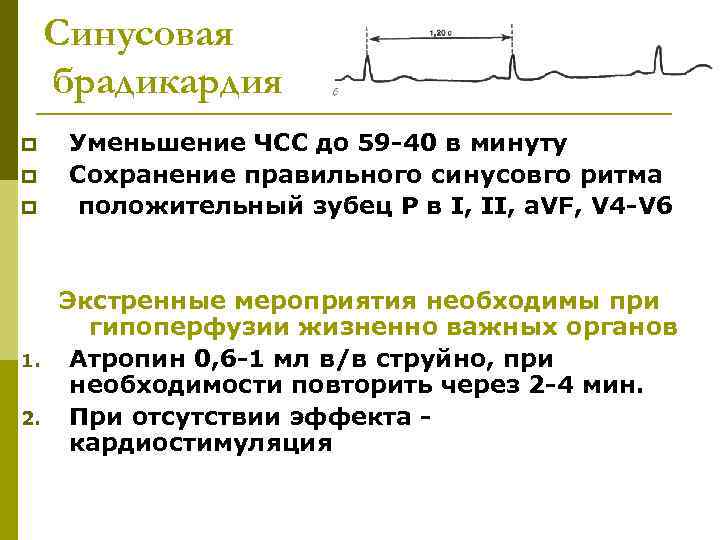 Синусовая брадикардия p p p 1. 2. Уменьшение ЧСС до 59 -40 в минуту