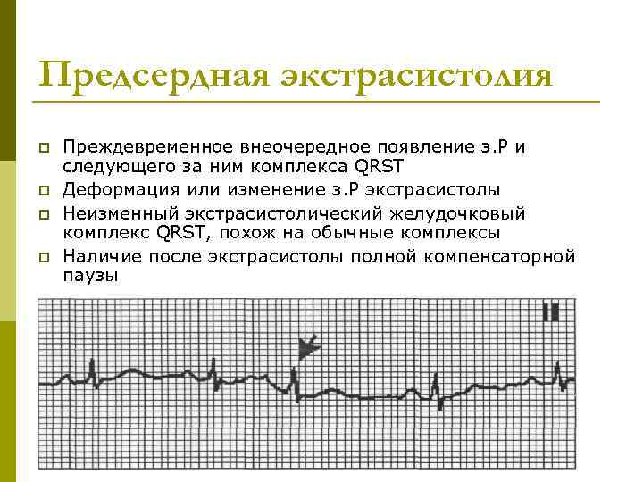 Предсердная экстрасистолия p p Преждевременное внеочередное появление з. Р и следующего за ним комплекса