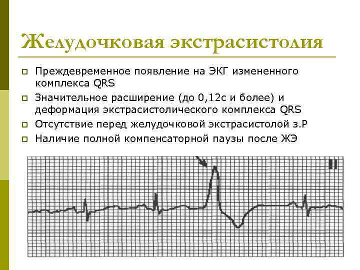 Желудочковая экстрасистолия p p Преждевременное появление на ЭКГ измененного комплекса QRS Значительное расширение (до