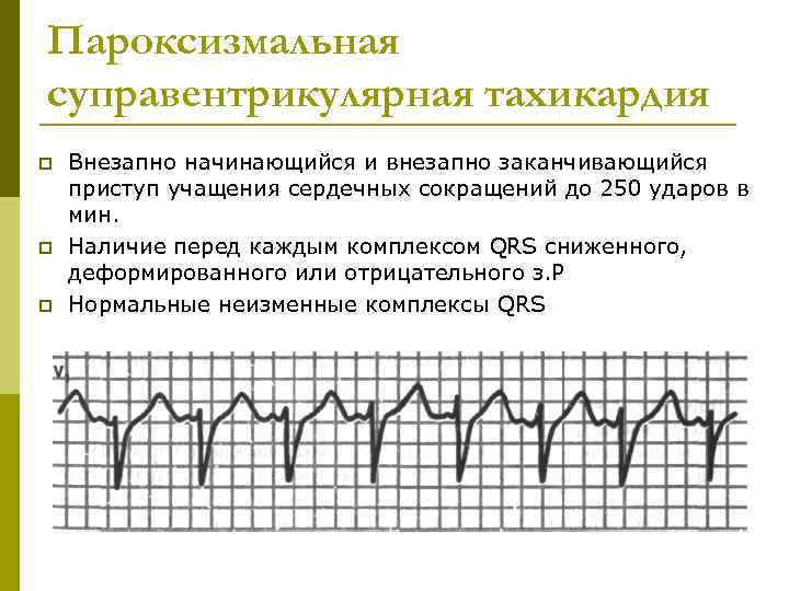 Пароксизмальная суправентрикулярная тахикардия p p p Внезапно начинающийся и внезапно заканчивающийся приступ учащения сердечных