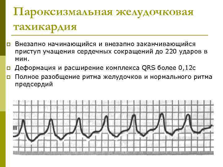 Пароксизмальная желудочковая тахикардия p p p Внезапно начинающийся и внезапно заканчивающийся приступ учащения сердечных