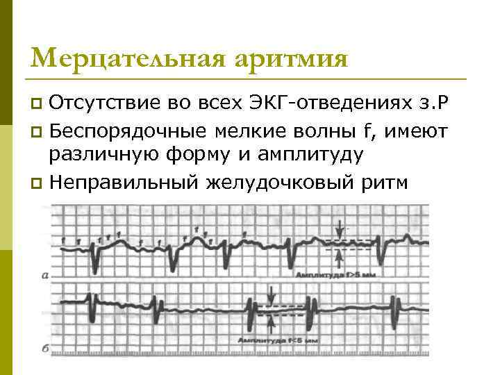 Мерцательная аритмия Отсутствие во всех ЭКГ-отведениях з. Р p Беспорядочные мелкие волны f, имеют