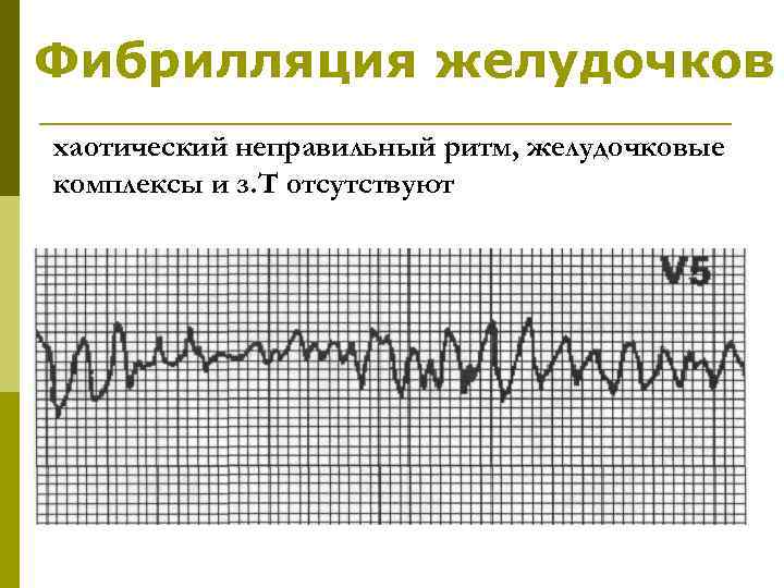 Фибрилляция желудочков хаотический неправильный ритм, желудочковые комплексы и з. Т отсутствуют 