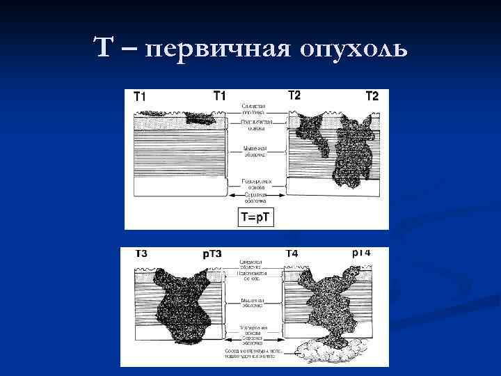 T – первичная опухоль 