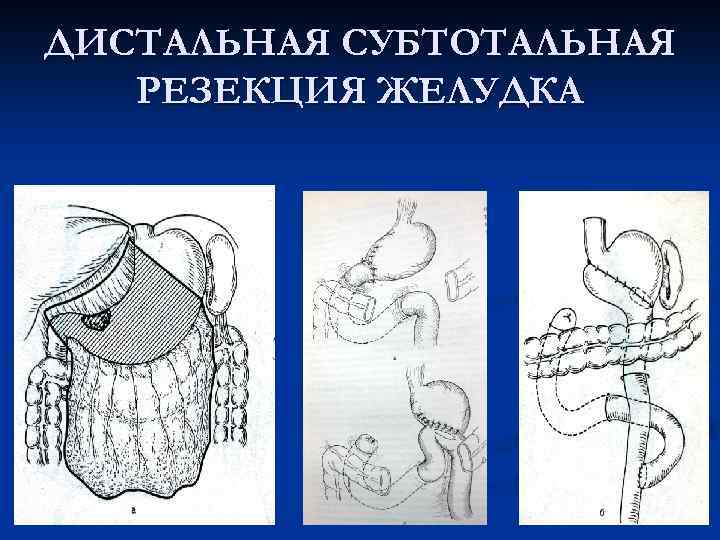 Резекция желудка схема