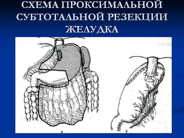  СХЕМА ПРОКСИМАЛЬНОЙ СУБТОТАЛЬНОЙ РЕЗЕКЦИИ ЖЕЛУДКА 