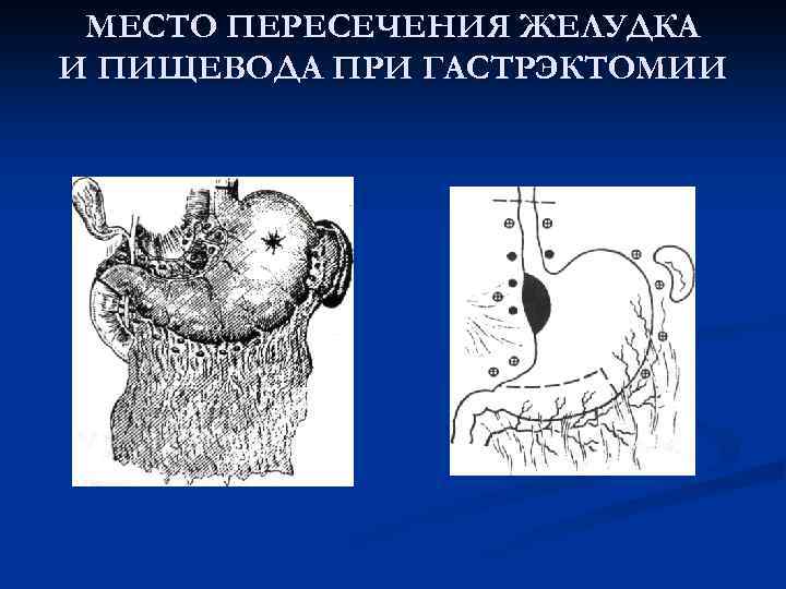  МЕСТО ПЕРЕСЕЧЕНИЯ ЖЕЛУДКА И ПИЩЕВОДА ПРИ ГАСТРЭКТОМИИ 