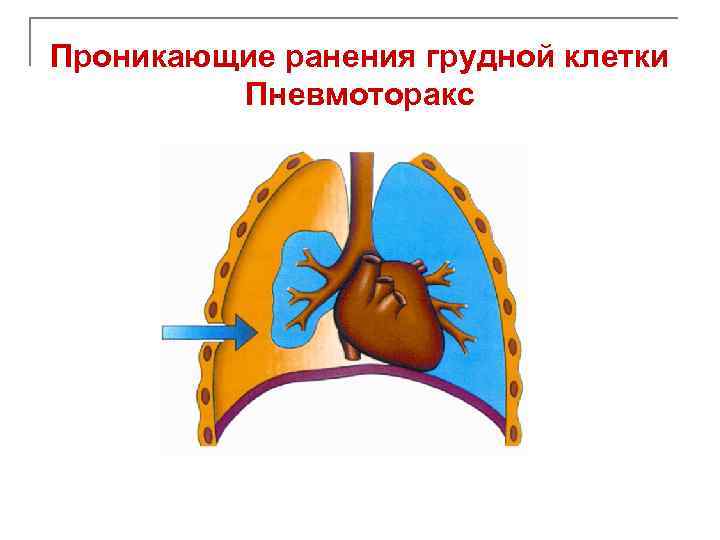 Проникающие раны грудной клетки. Проникающее ранение грудной клетки пневмоторакс. Ножевое ранение грудной клетки компрессионный пневмоторакс. Проникающее ранение грудной клетки справа, открытый пневмоторакс.. При проникающем ранении грудной клетки и развитии пневмоторакса:.