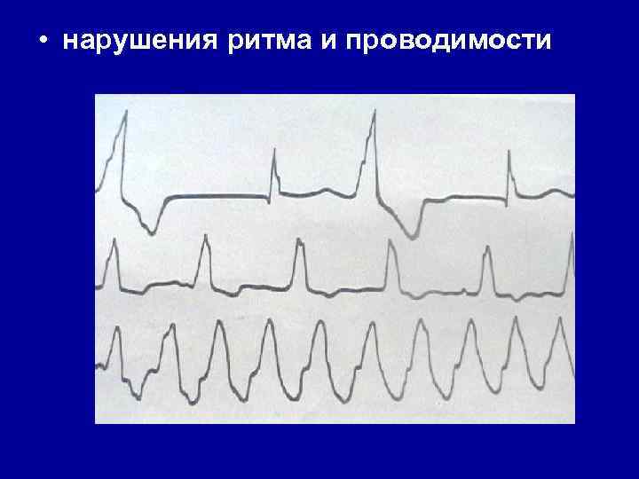 Нарушение проводимости сердца. Нарушение ритма и проводимости. Нарушения сердечного ритма и проводимости. Нарушение ритма и проводимости сердца ЭКГ. Аритмия связанная с нарушением проводимости.