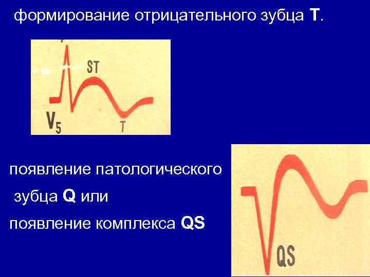 Для патологического зубца q характерно. Патологический зубец q (или комплекс QS);. Формирование патологического зубца q. Формирование отрицательного зубца т. Появления зубца q.