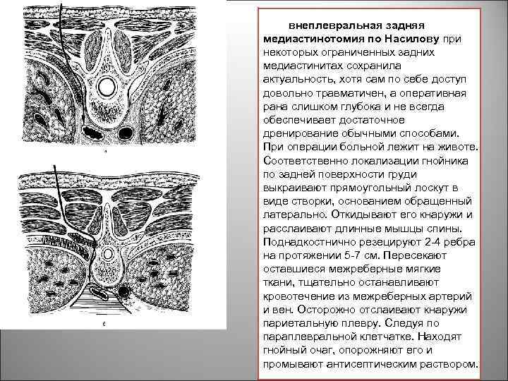 Медиастинит клиническая картина