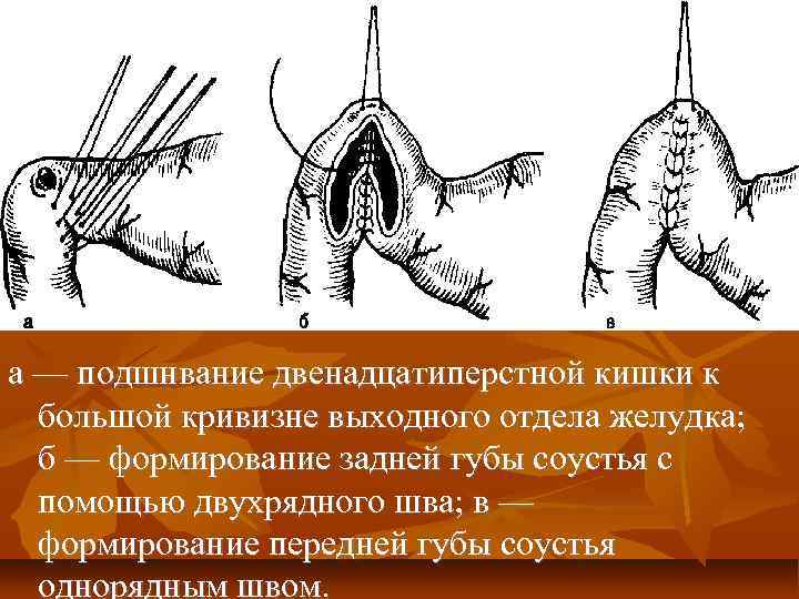 а — подшнвание двенадцатиперстной кишки к большой кривизне выходного отдела желудка; б — формирование