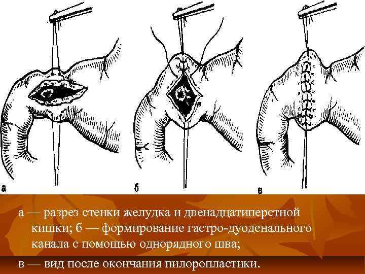 а — разрез стенки желудка и двенадцатиперстной кишки; б — формирование гастро дуоденального канала