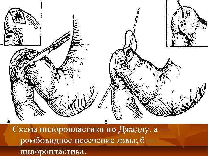Схема пилоропластики по Джадду. а — ромбовидное иссечение язвы; б — пилоропластика. 