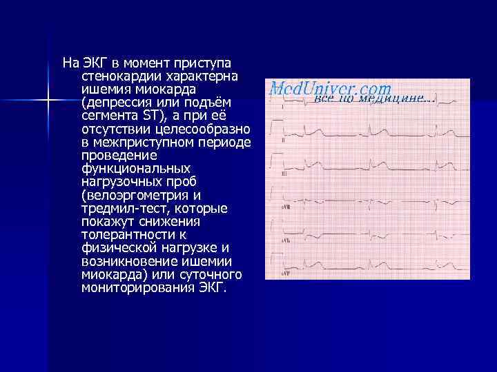 На ЭКГ в момент приступа стенокардии характерна ишемия миокарда (депрессия или подъём сегмента ST),