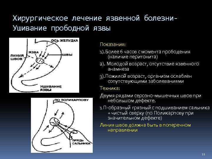 Хирургическое лечение язвенной болезни. Ушивание прободной язвы Показания: 1). Более 6 часов с момента