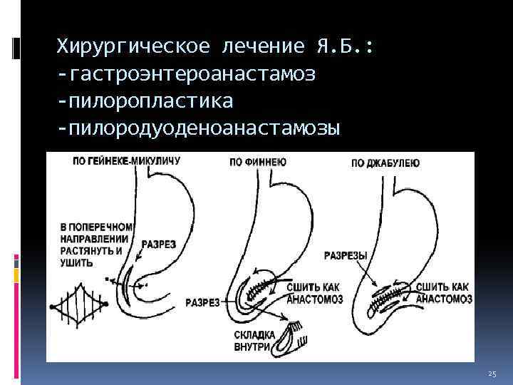 Хирургическое лечение Я. Б. : -гастроэнтероанастамоз -пилоропластика -пилородуоденоанастамозы 25 