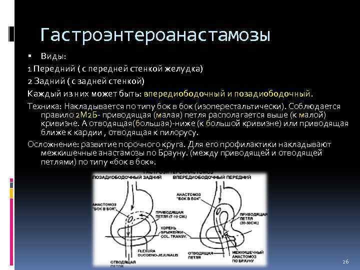 Гастроэнтероанастамозы Виды: 1 Передний ( с передней стенкой желудка) 2 Задний ( с задней