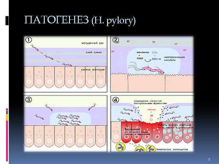 ПАТОГЕНЕЗ (H. pylory) 5 