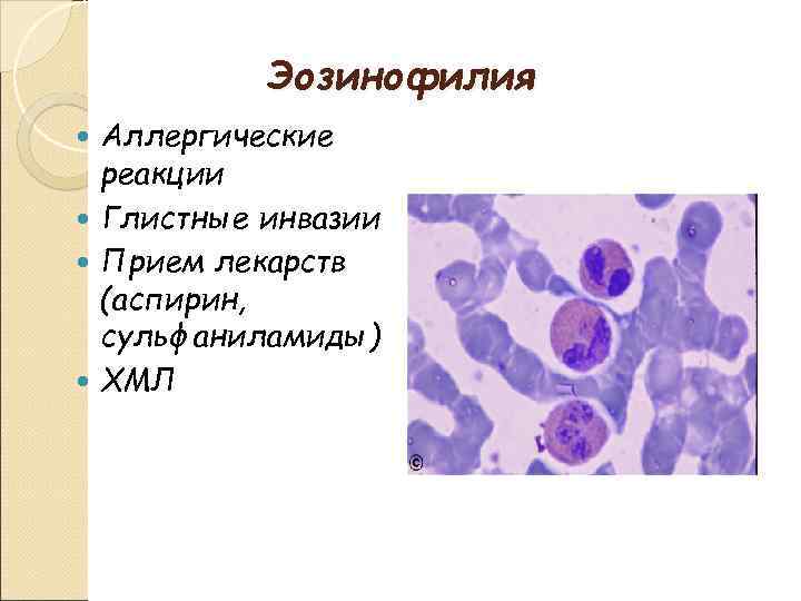 Эозинофилия Аллергические реакции Глистные инвазии Прием лекарств (аспирин, сульфаниламиды) ХМЛ 