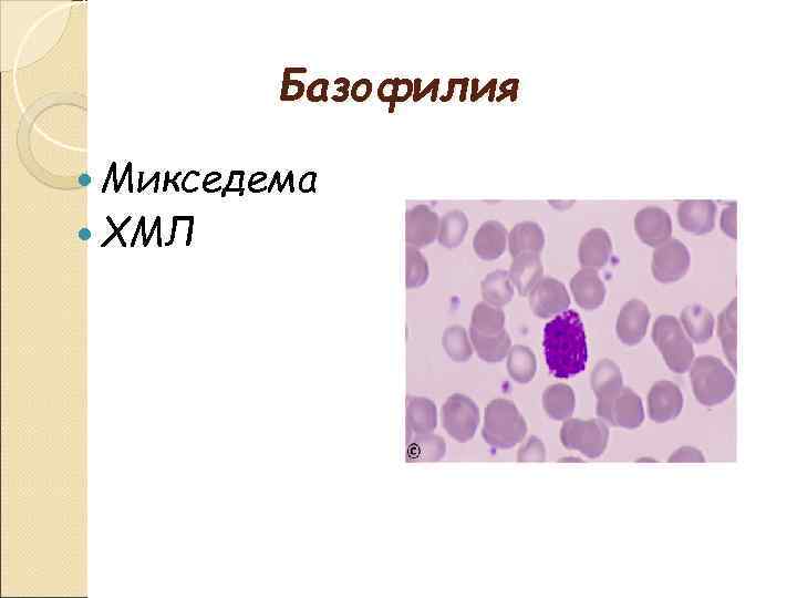 Базофилия Микседема ХМЛ 