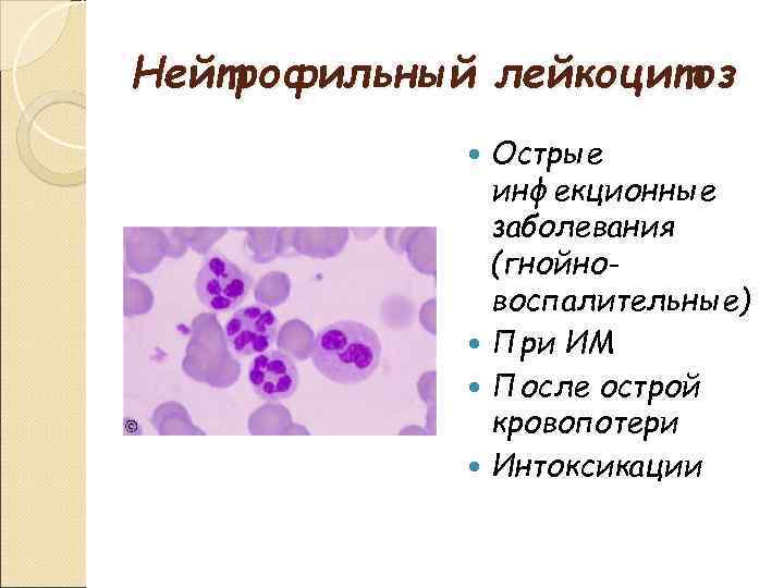 Нейтрофильный лейкоцитоз Острые инфекционные заболевания (гнойновоспалительные) При ИМ После острой кровопотери Интоксикации 