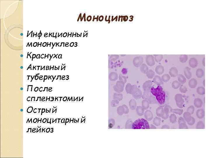 Моноцитоз Инфекционный мононуклеоз Краснуха Активный туберкулез После спленэктомии Острый моноцитарный лейкоз 