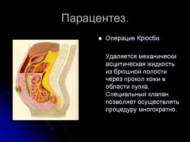 Парацентез. l Операция Крюсби. Удаляется механически асцитическая жидкость из брюшной полости через прокол кожи