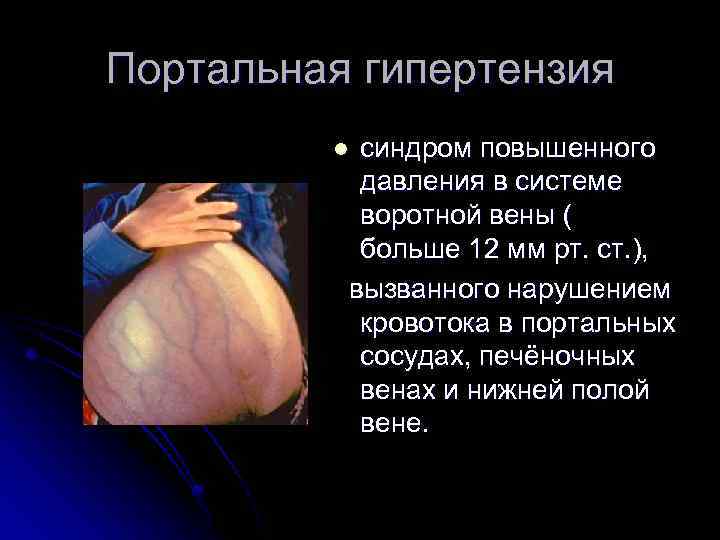 Портальная гипертензия синдром повышенного давления в системе воротной вены ( больше 12 мм рт.