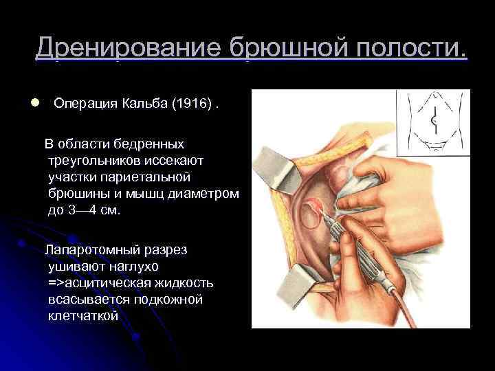  Дренирование брюшной полости. l Операция Кальба (1916). В области бедренных треугольников иссекают участки