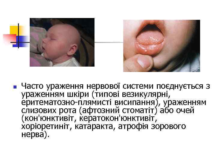 n Часто ураження нервової системи поєднується з ураженням шкіри (типові везикулярні, еритематозно-плямисті висипання), ураженням