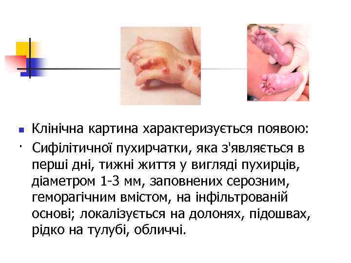 Клінічна картина характеризується появою: · Сифілітичної пухирчатки, яка з'являється в перші дні, тижні життя