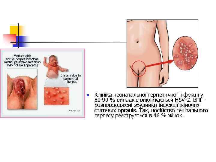 n Клініка неонатальної герпетичної інфекції у 80 -90 % випадків викликається HSV-2. ВПГ -