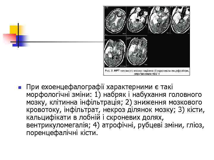 n При ехоенцефалографії характерними є такі морфологічні зміни: 1) набряк і набухання головного мозку,