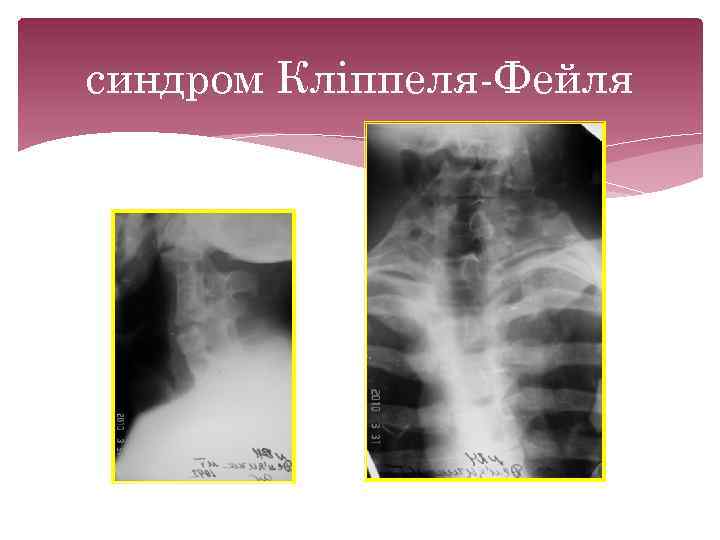 синдром Кліппеля Фейля 