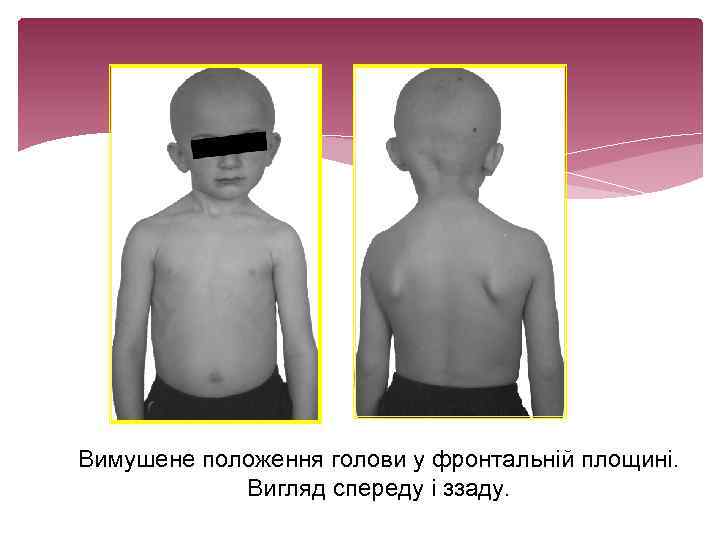 Вимушене положення голови у фронтальній площині. Вигляд спереду і ззаду. 