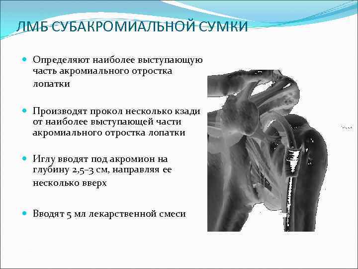 ЛМБ СУБАКРОМИАЛЬНОЙ СУМКИ Определяют наиболее выступающую часть акромиального отростка лопатки Производят прокол несколько кзади