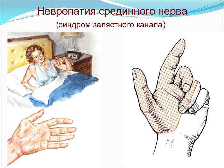 Невропатия срединного нерва (синдром запястного канала) 