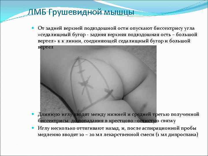 ЛМБ Грушевидной мышцы От задней верхней подвздошной ости опускают биссектрису угла «седалищный бугор -