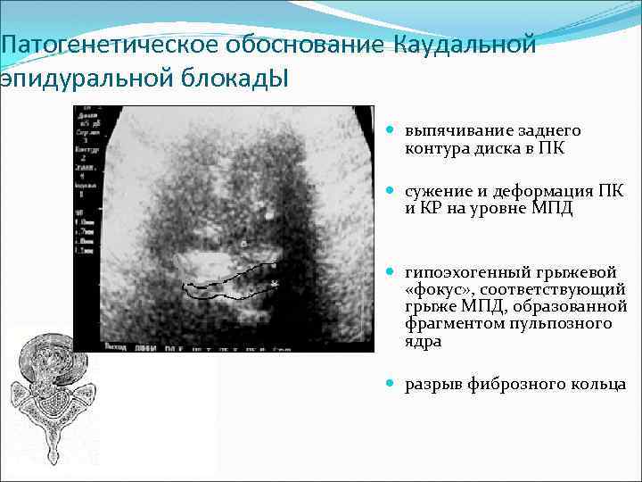 Патогенетическое обоснование Каудальной эпидуральной блокад. Ы выпячивание заднего контура диска в ПК сужение и