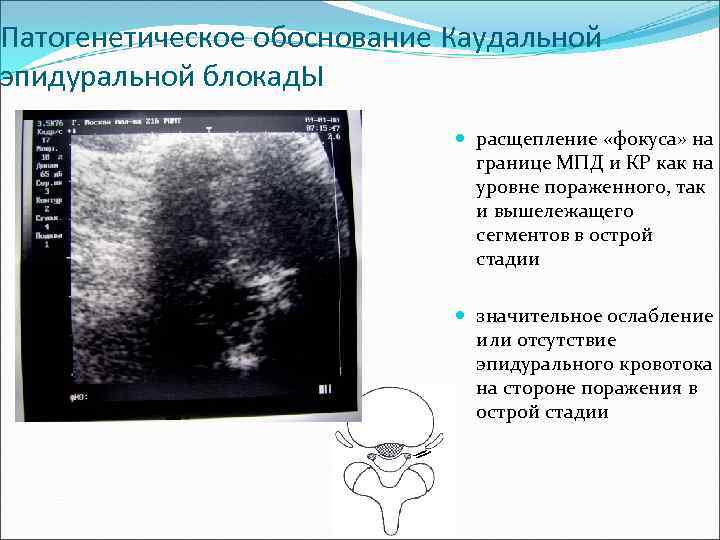 Патогенетическое обоснование Каудальной эпидуральной блокад. Ы расщепление «фокуса» на границе МПД и КР как