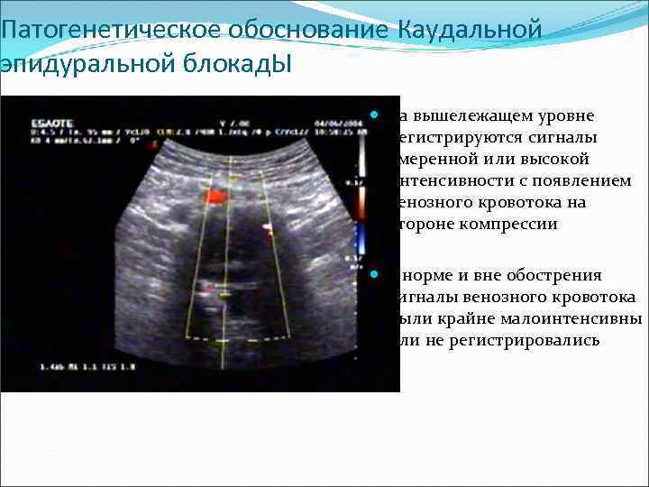 Патогенетическое обоснование Каудальной эпидуральной блокад. Ы на вышележащем уровне регистрируются сигналы умеренной или высокой